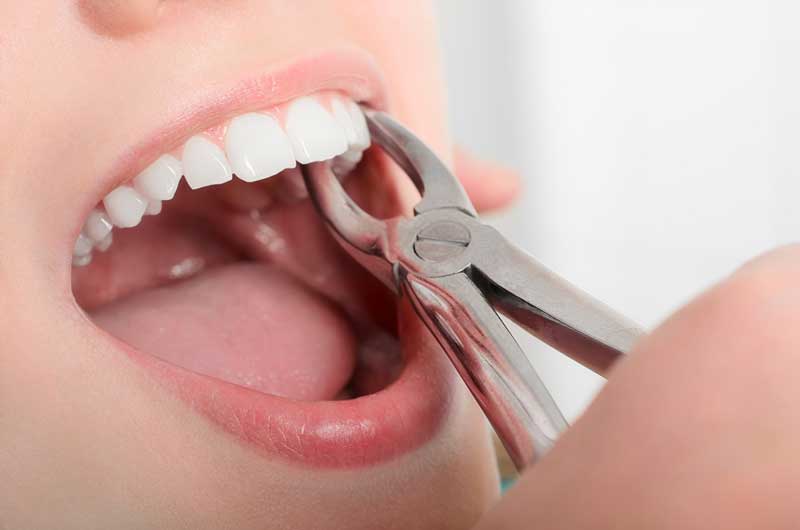 vadjenje-zuba