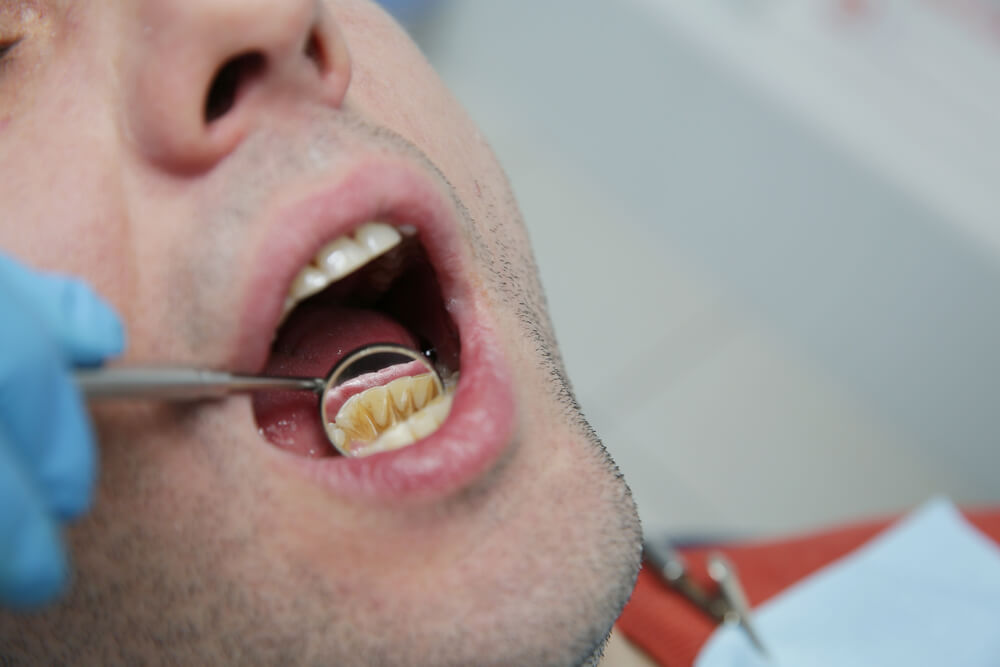 Skidanje zubnog kamenca