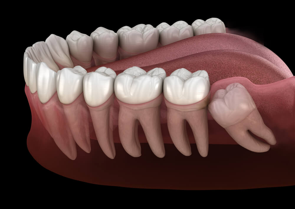 Impaktirani zubi 